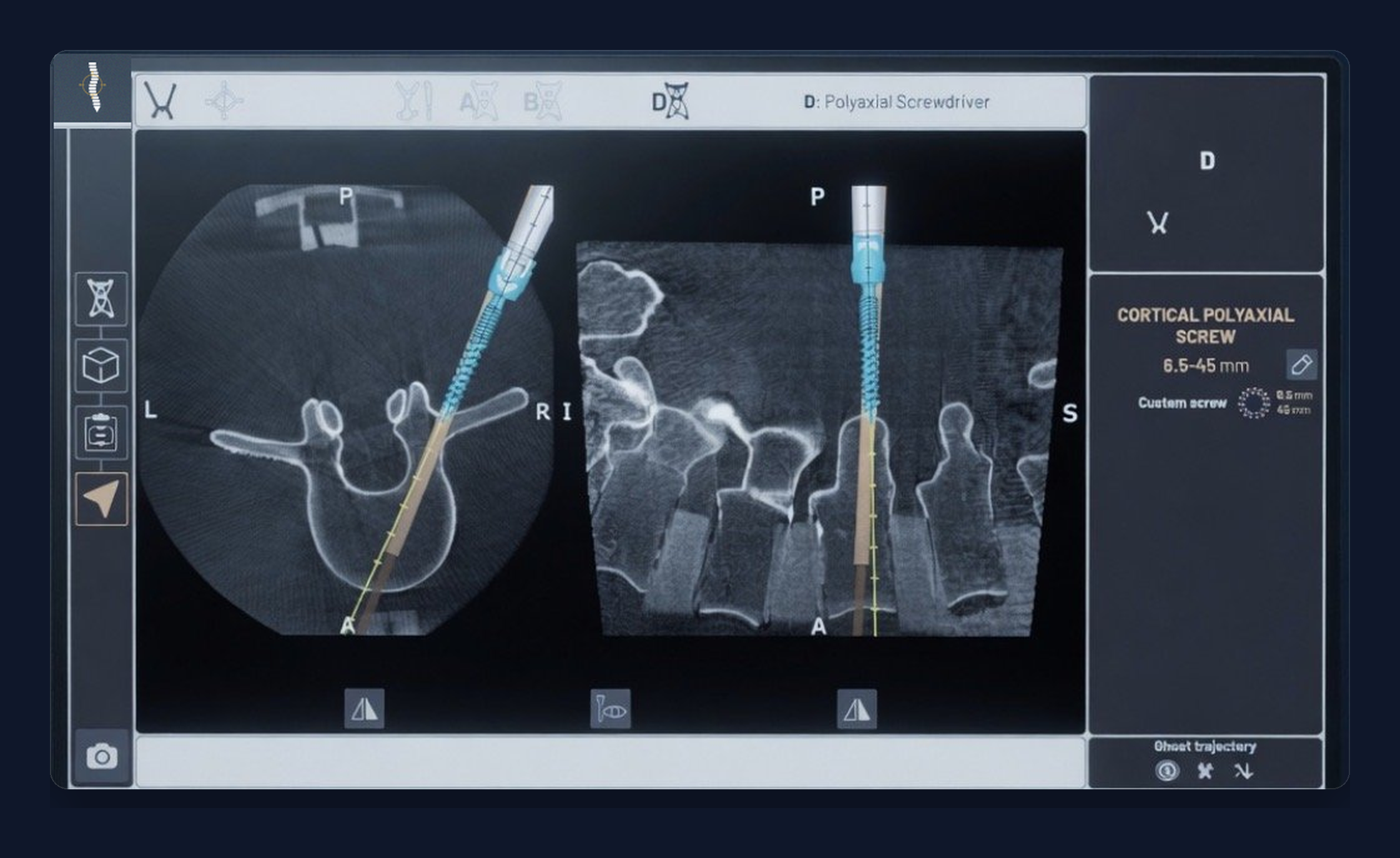 VexNav Op.N navigation display showing the original medical planning interface