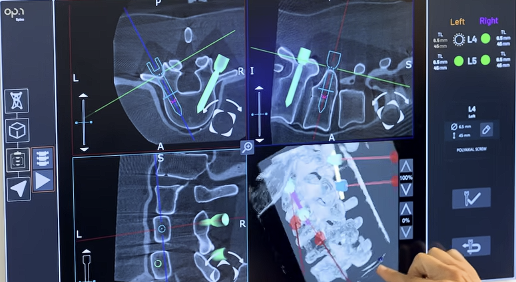 Multiplanar spinal navigation views on the VEXUS display